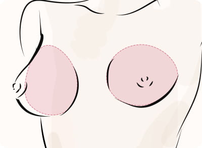 豊胸術（シリコンバック・脂肪注入CRF）