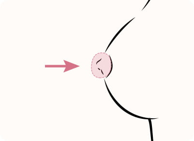 乳頭縮小