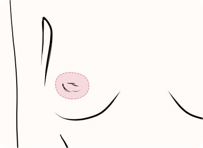 陥没乳頭