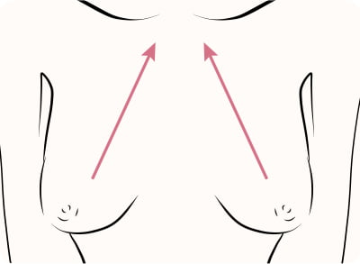 乳房つり上げ術