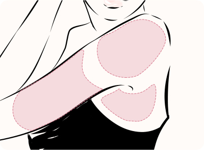 脂肪吸引（上腕）（スタンダード）