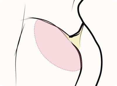 脂肪吸引（臀部）（スタンダード）