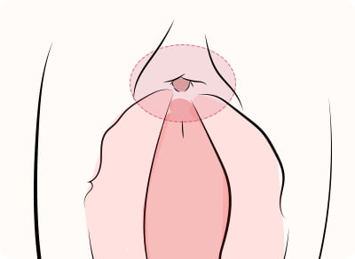 クリトリス包茎ケア