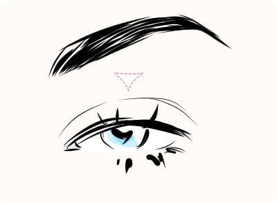 切らない眼瞼下垂術