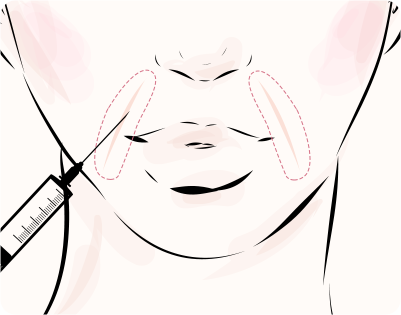 ヒアルロン酸注入