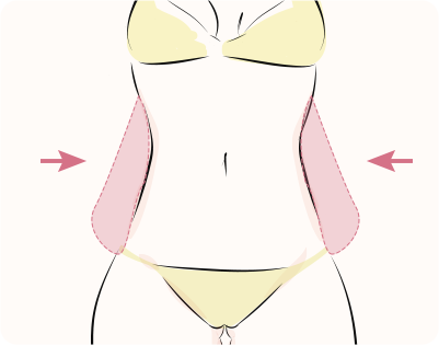 脂肪吸引（腹部）（ベイザー・アキーセル）